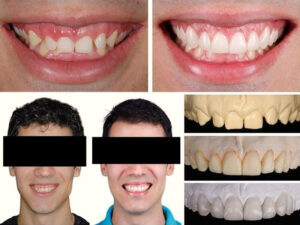 facetas dentárias