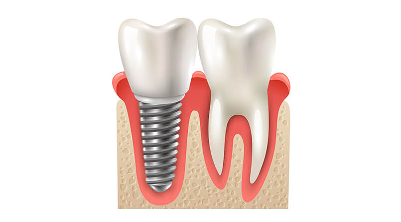 4 coisas que você precisa saber sobre os implantes dentários
