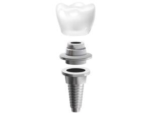 4 coisas que você precisa saber sobre os implantes dentários