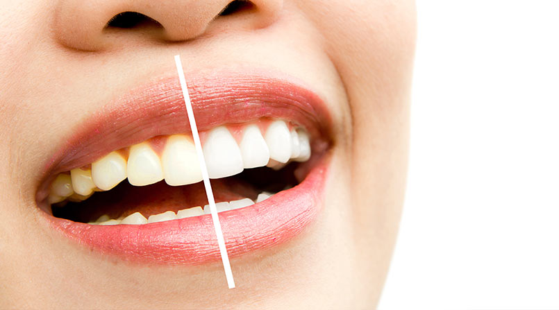 Mitos e Verdades sobre o Clareamento Dental