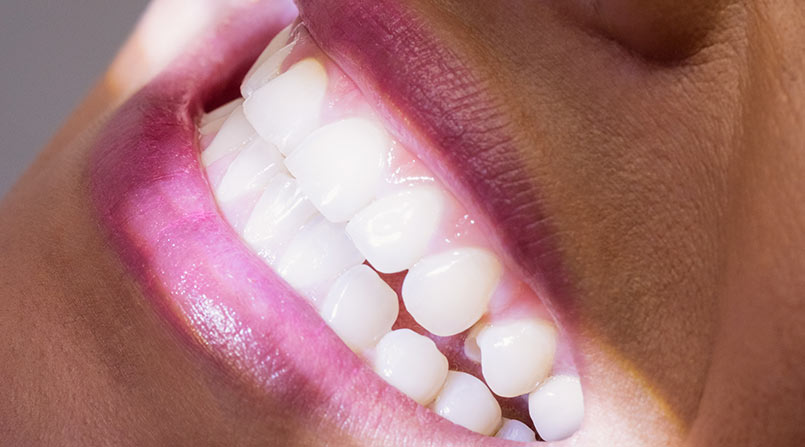 Quando as lentes de contato dental são indicadas?