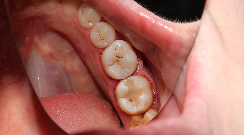 Cáries Dentárias: Causas, Prevenção e Tratamento Completo