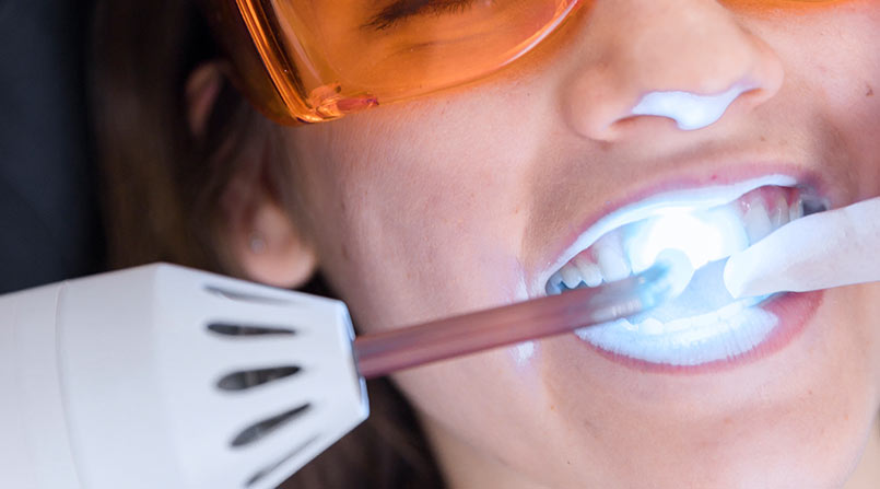 MITOS E VERDADES DO CLAREAMENTO DENTAL