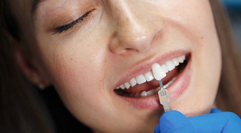 QUANDO USAR LENTES DE CONTATO DENTAL